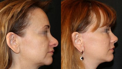 Rhinoplasty дейін және кейін