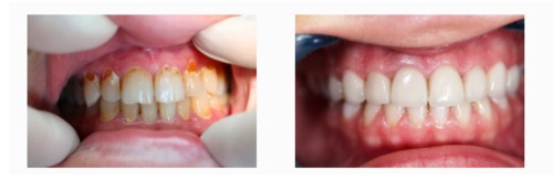 Dental Dynastia-да орнатылған винирлер 