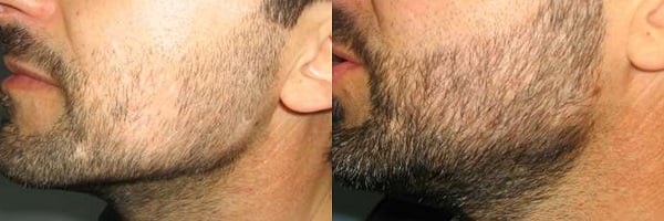 Beard hair transplant